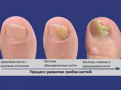 Лечение грибка на ногтях ног фото до и после | Клиника АЛОДЕРМ , Москва