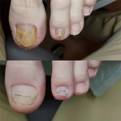 Тяжелейшие осложнения: врач Мясников раскрыл опасность лечения грибка  ногтей народными методами