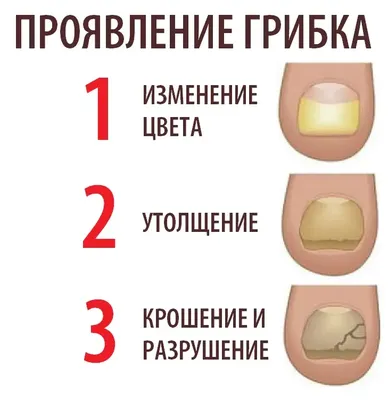 Лечение грибка ногтей в Москве - врач-подолог, цены от 1500 руб!
