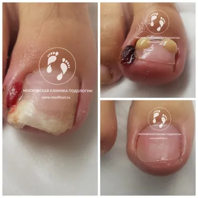 Лечение застарелого грибка ногтей | Клиника АЛОДЕРМ Москва