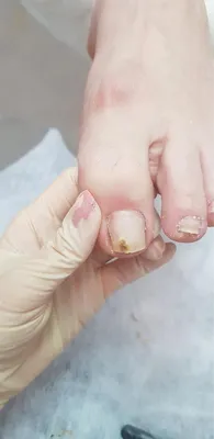 Грибок ногтей: симптомы, признаки и причины появления грибка на ногтях