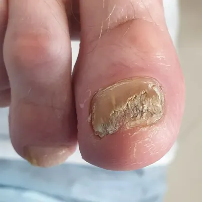 Лечение грибка ногтей (онихомикоз) - блог Виртус