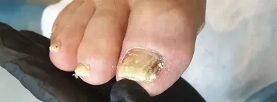 Как узнать, что у тебя грибок ногтей - YouTube