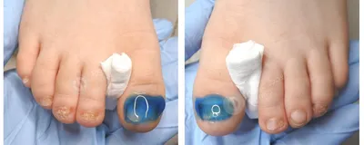 Грибок ногтей на ногах | Лечение онихомикоза под ногтем