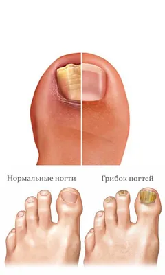 Грибок ногтей - лечение \"Любава\" Косметологический Центр г.  Николаев\"Любава\" Центр Эстетической Косметологии г. Николаев