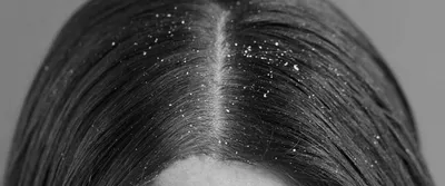 Зуд кожи головы - Клиника Марины Рябус
