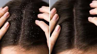Псориаз волосистой части головы – Лечение псориаза головы – Симптомы и  причины псориаза на голове - Клиника «Доктор Волос»
