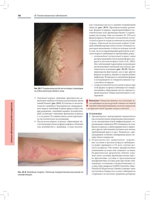 Cutaneous T-cell lymphoma: Differential diagnostics of erythrodermic  conditions | Semantic Scholar