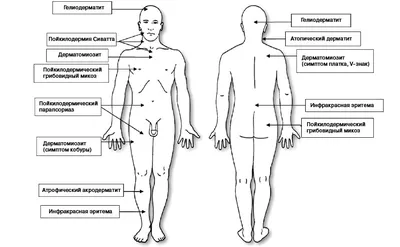 PDF) Molecular genetic features of cutaneous T-cell lymphomas development  on example of mycosis fungoides and Sezary syndrome