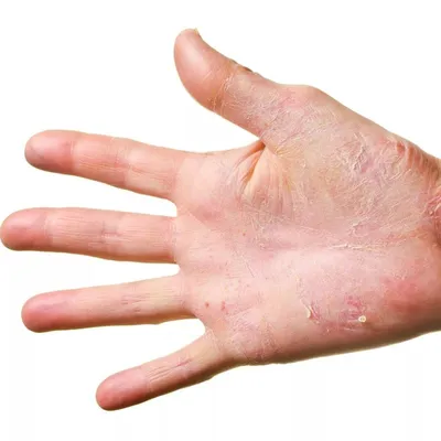 Грибок на человеческой коже Макрос Стоковое Фото - изображение  насчитывающей дермально, обесцвещено: 100860328