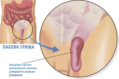 Пахова грижа - симптоми і методи її лікування