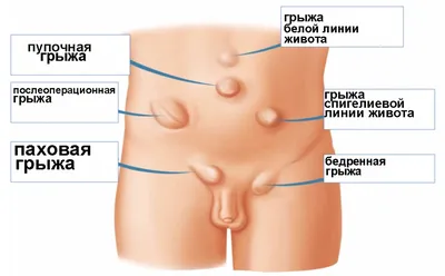 Грыжи белой линии живота | Со слов Детского Хирурга | Дзен