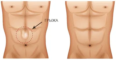 Пупочные грыжи, грыжи белой линии живота и диастаз прямых мышц живота |