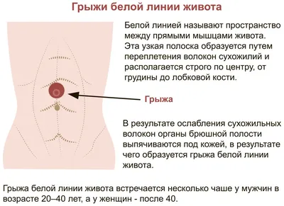 Диастаз прямых мышц живота - симптомы, причины, лечение