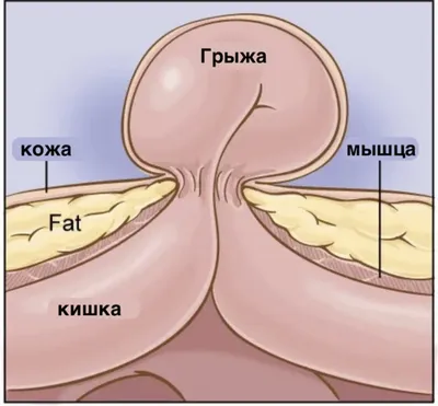 Грыжи белой линии живота | Со слов Детского Хирурга | Дзен