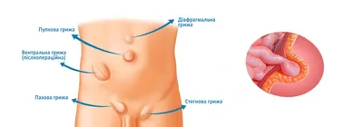 Диастаз: лечение, симптомы, причины, диагностика, последствия, виды и  профилактика заболевания