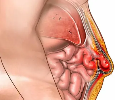 Грыжа белой линии живота Форум