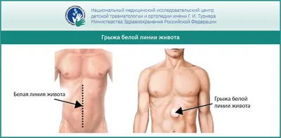 Грыжа белой линии живота у ребенка: основные аспекты, рекомендации врачей и  методы лечения