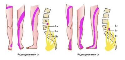 Грыжа диска L4-L5: причины, симптомы и лечение