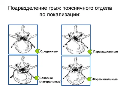 Грыжа диска L4