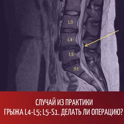 Грыжа L4-L5; L5-S1. Нужна ли операция? | Реабилитация ONLINE | Дзен