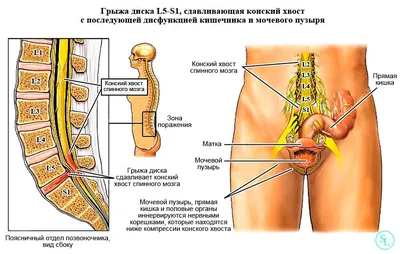 Дорзальная грыжа диска - медианная, парамедианная L4-L5-S1 симптомы и  лечение