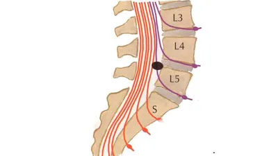 Грыжа диска L3 | Первая Медицинская Клиника | Дзен