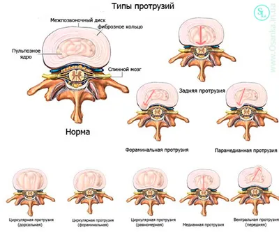 Дорзальная грыжа диска - медианная, парамедианная L4-L5-S1 симптомы и  лечение