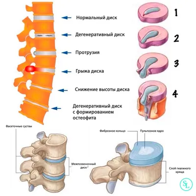 Секвестрированная грыжа диска позвоночника, L4–L5, L5–S1, C5–C6 поясничного  отдела, операция, симптомы