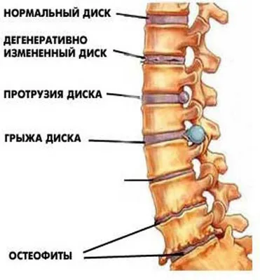 Межпозвонковая грыжа. Лечение грыжи позвоночника без операции в Киеве. -  Vertebra