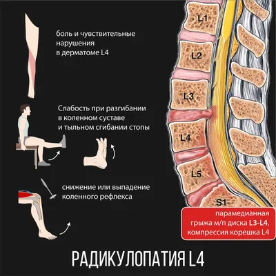 Грыжа в пояснице L4-L5, L5-S1 Или к чему привели 12 лет борьбы |  Нарисованное небо | Дзен