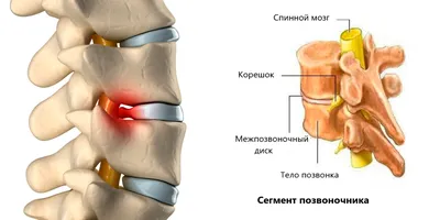 Грыжа позвоночника поясничного отдела [лечение и симптомы]