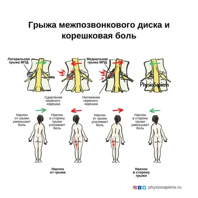 Дорзальная грыжа межпозвонкового диска - что это такое и как лечить