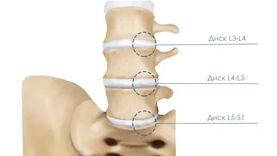 Stories of the treatment of intervertebral hernias and protrusions of our  patients without surgery, their MRI results and reviews - Vertebra