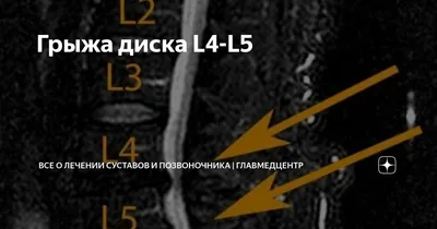 ⭕ Грыжа диска L4-L5 - что делать? - YouTube