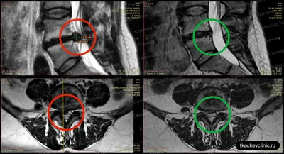 Магнитно-резонансная Томография (МРТ) Пояснично-крестцового Шипами  Демонстрирующий Грыжа Диска В L3-L4 И L4-L5 С Красным Цветом Фотография,  картинки, изображения и сток-фотография без роялти. Image 25571551