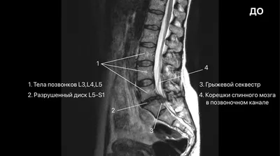 Грыжа межпозвонкового диска L4-L5 - симптомы, диагностика, лечение без  операции