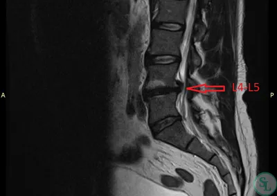 Восходящая грыжа м/п диска L4-L5