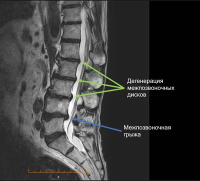 Лечение всех видов грыжи позвоночника - Клиника А.Н. Бакланова