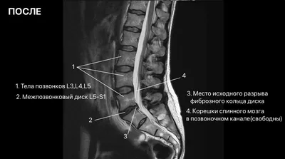 Протрузии межпозвонковых дисков поясничного отдела позвоночника | Второе  мнение