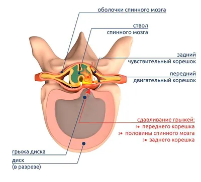 МРТ и КТ Рязань - Клиника-Сити - Секвестрированная грыжа позвоночника –  результат осложнения межпозвонковой грыжи. Заболевание приводит к тому, что  больной испытывает невыносимые боли в пояснице, отдающие в ногу и ягодицу.  Нередко