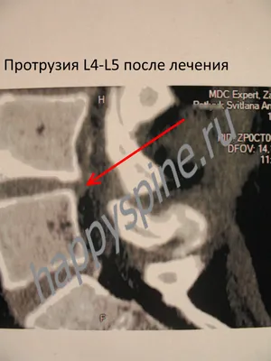 Протрузии межпозвонковых дисков МРТ | Второе мнение