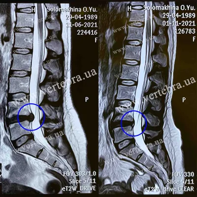 Результаты лечения межпозвонковых грыж и протрузий без операции, снимки МРТ  до и после, отзывы - Vertebra