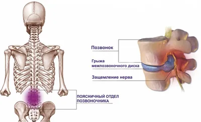 Парамедианная грыжа диска - причины и особенности заболевания