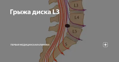 Грыжа L4-L5; L5-S1. Нужна ли операция? | Реабилитация ONLINE | Дзен