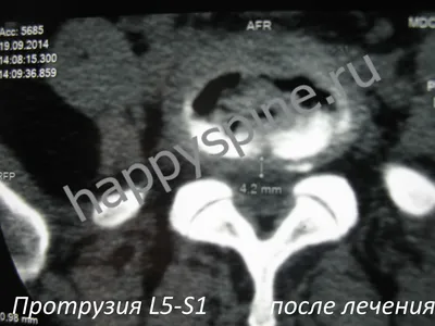 Грыжа диска L4-L5 поясничного отдела размером 21 мм. Лечение.