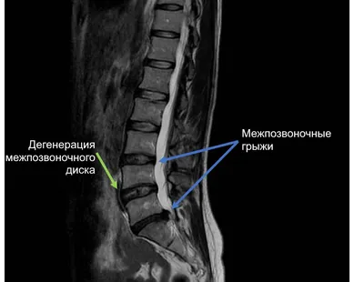 Результаты лечения межпозвонковых грыж и протрузий без операции, снимки МРТ  до и после, отзывы - Vertebra