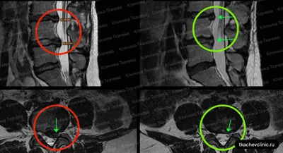 Лечение межпозвонковой грыжи без операции в клинике Вертебра - Vertebra