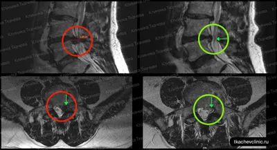 Грыжа поясничного отдела позвоночника - Клиника вертеброневрологии