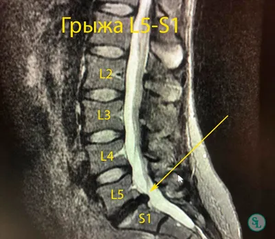 Как болит межпозвонковая грыжа диска позвоночника